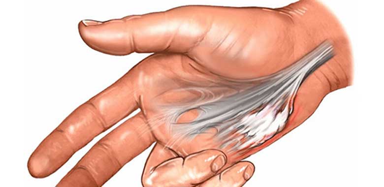 Dupuytren Kontraktürü 