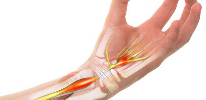Karpal Tünel Tanısı Nasıl Konur ?