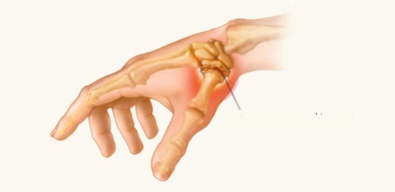 Başparmak Kök Eklemi Kireçlenmesi