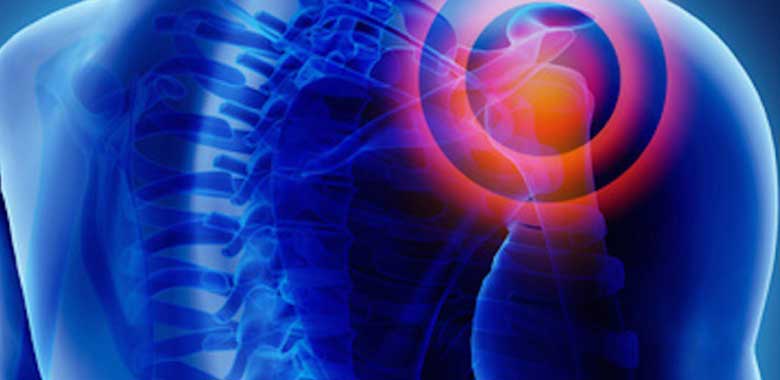 Omuz İnstabilitesi Nedir?