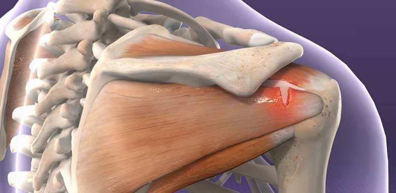 Rotator Kılıf Onarım Cerrahisi
